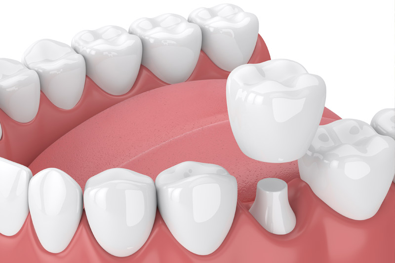 Dental Crowns in Norwalk