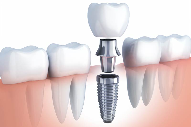 Implants Dentist in Norwalk