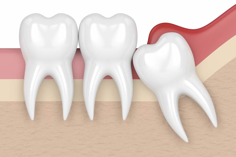 Wisdom Tooth Removal in Norwalk